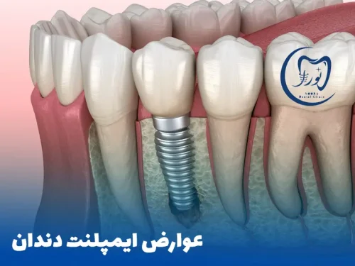 عوارض ایمپلت دندان- تحلیل استخوان