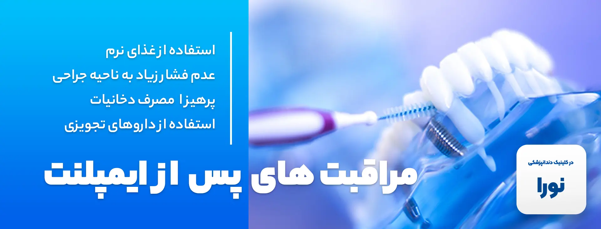 ایمپلنت در کرج - ایمپلنت دندان - مراقبت های پس از انجام ایمپلنت دندان