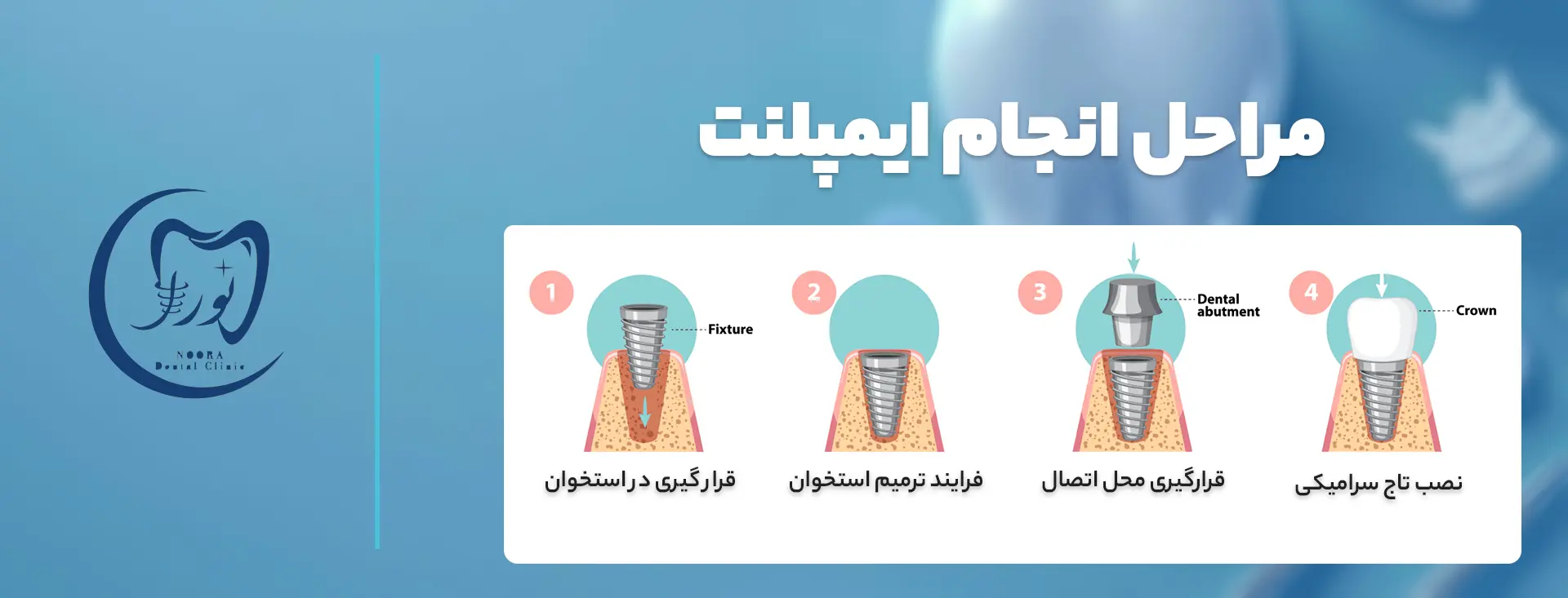 ایمپلنت در کرج - ایمپلنت دندان - مراحل انجام ایمپلنت دندان