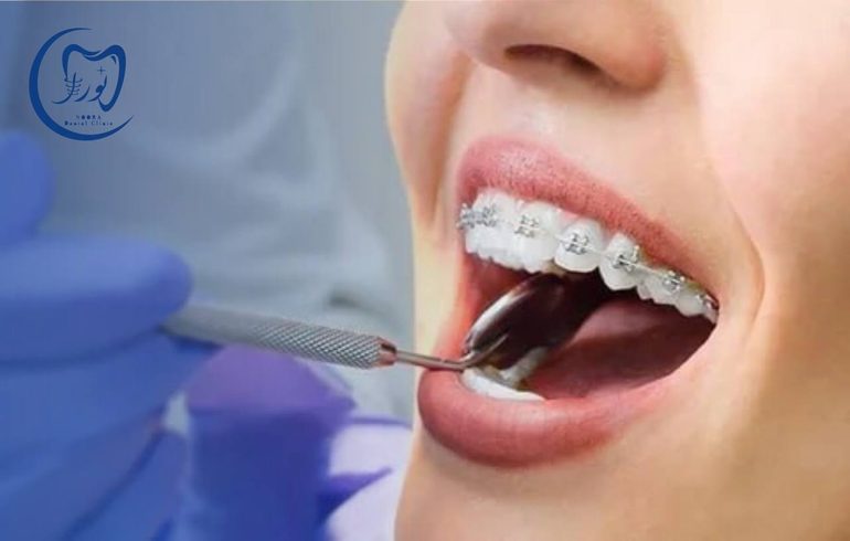 انجام ارتودنسی ثابت و نامرئی در کرج | کلینیک نورا